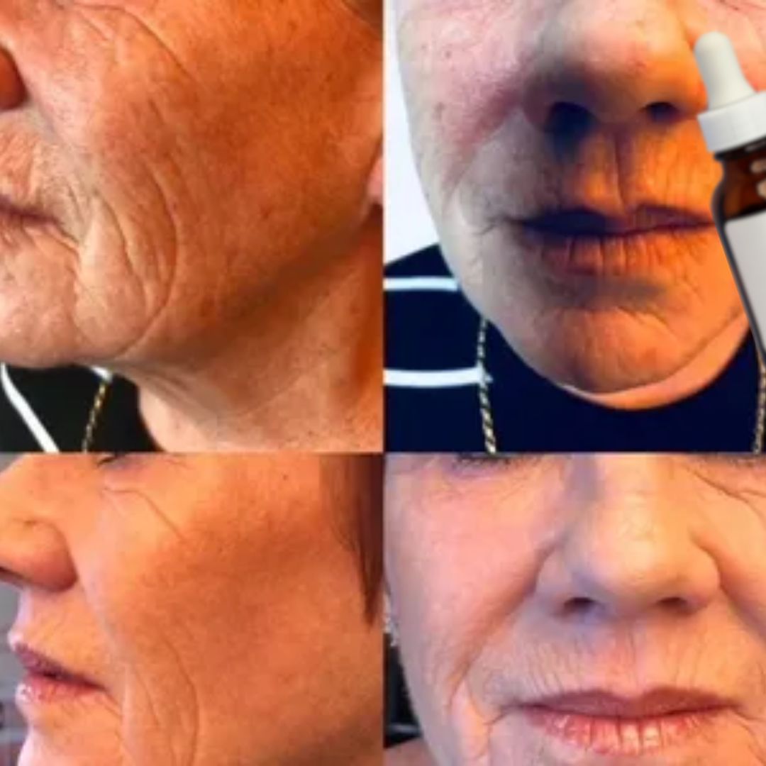 Facelift Treatments