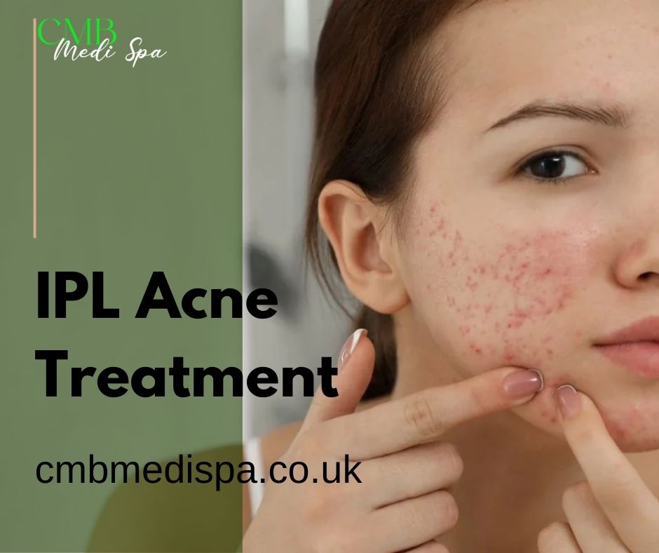 IPL Acne Treatment Plymouth