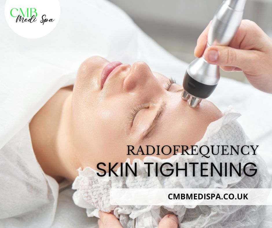 Radiofrequency Skin Tightening