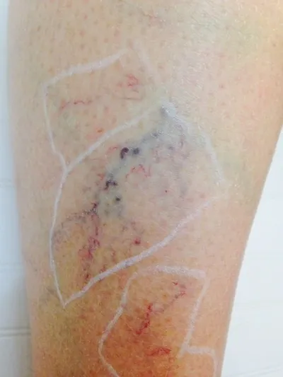 thread vein removal