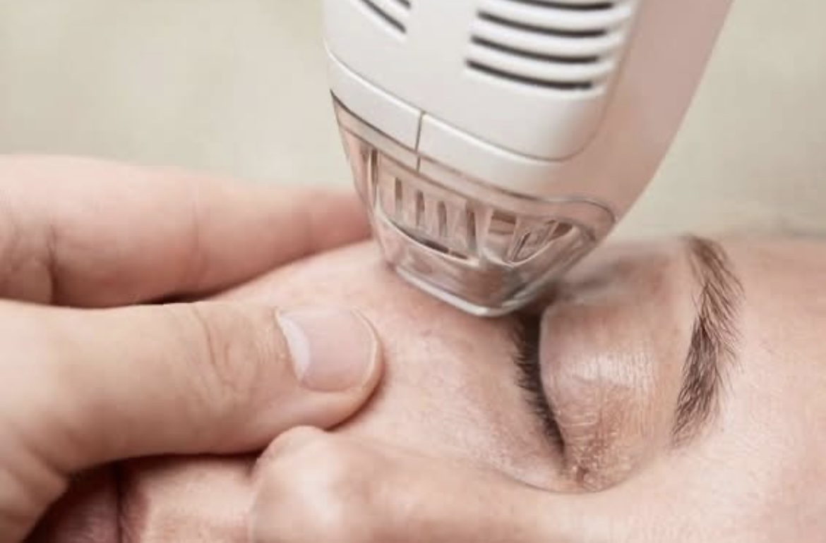 skin rejuvenation